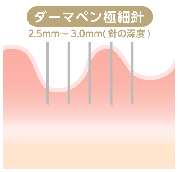 極細電動ニードルイメージ