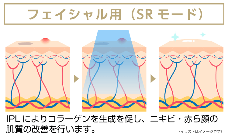 KalonS（カロンS）について