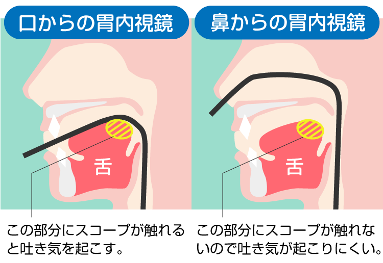 経鼻内視鏡イメージ図