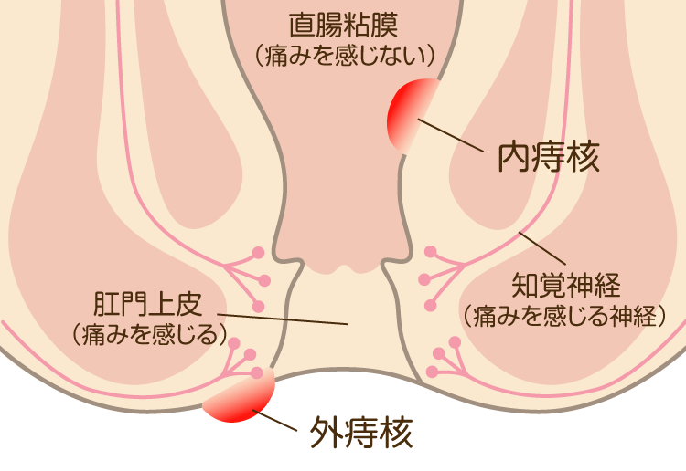 いぼ痔