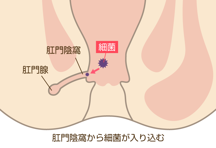 あな痔