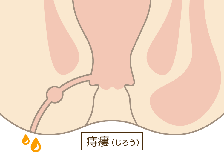 あな痔