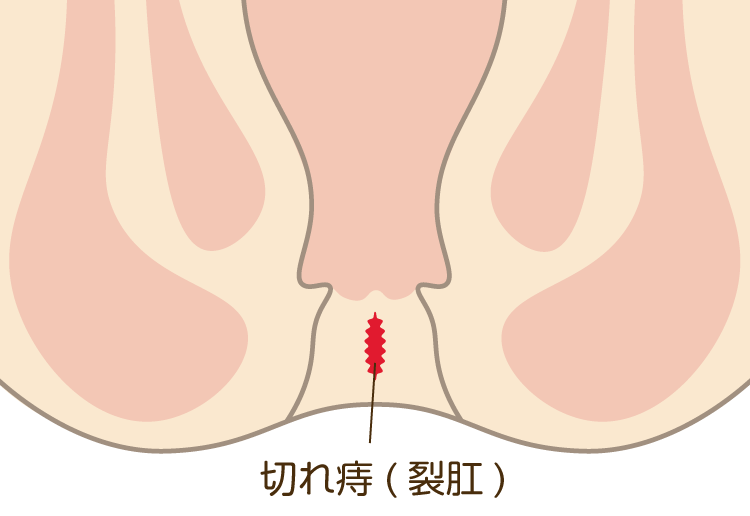 切れ痔